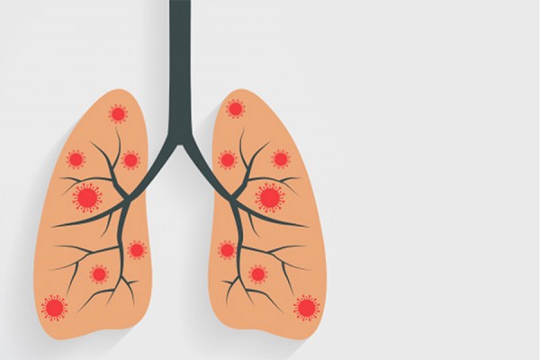 drawing of lungs infected with Novel Coronavirus